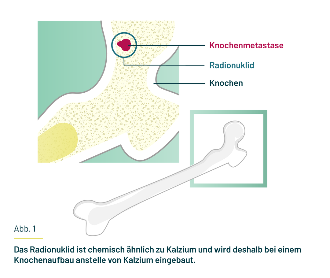 Das Radionuklid reichert sich an einer Knochenmetastase an und setzt dort radioaktive Strahlung frei.  Das Radionuklid reichert sich an einer Knochenmetastase an und setzt dort radioaktive Strahlung frei.