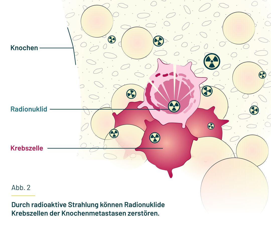 Das Radionuklid kann durch radioaktive Strahlung Krebszellen in den Metastasen zerstören. Das Radionuklid kann durch radioaktive Strahlung Krebszellen in den Metastasen zerstören.